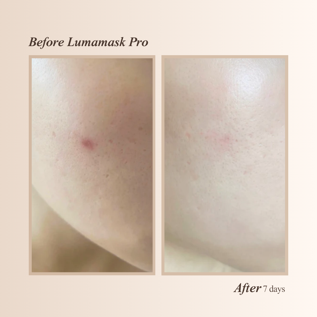 Lumamask Pro | LED Light Therapy Face Mask